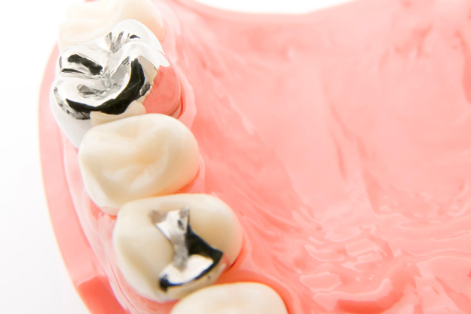 銀歯には金属アレルギーのリスクがあります